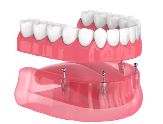 Mini Implant Retained Dentures